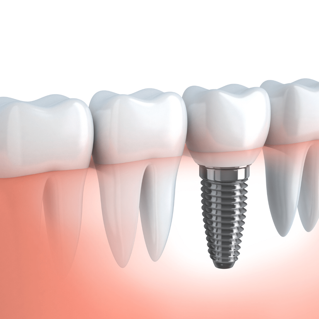 A tooth implant being placed in the middle of a row.